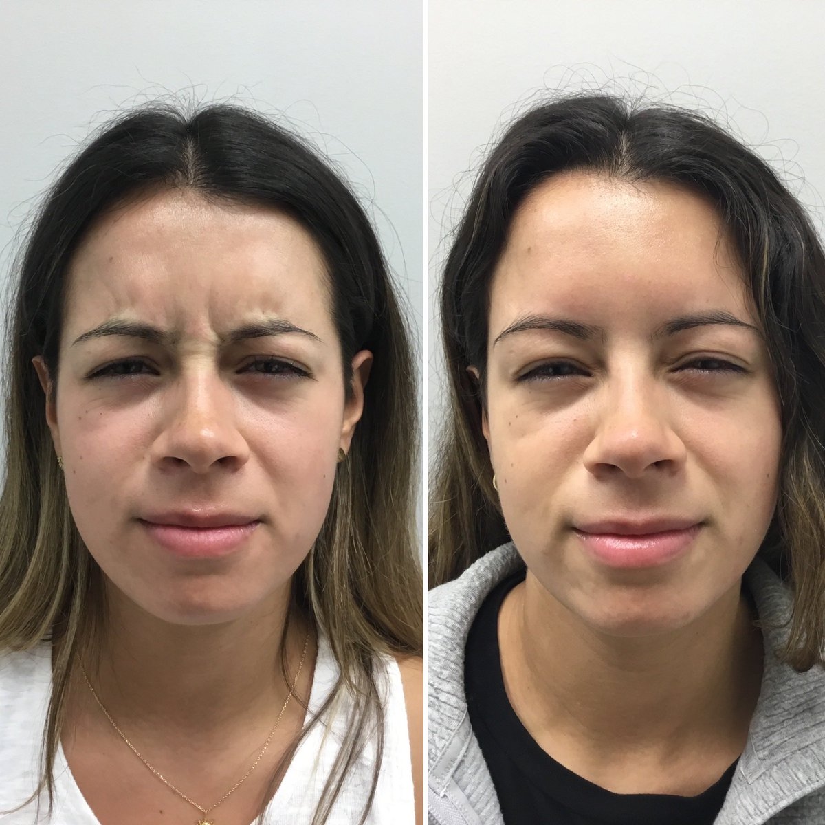 skinBeMedSpa's tweet photo. Just a little Tuesday reminder that Botox is amazing. 🤩🤩 #Botox #AntiAging #Aesthetics https://t.co/EDteWtnJ4P