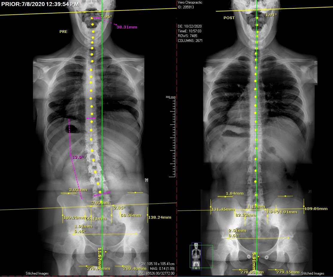 Vero_Chiro's tweet photo. How it started vs. how it's going. 🤩 Check out these X-ray changes after just 3.5 months of care! https://t.co/qzDKhTOqyN