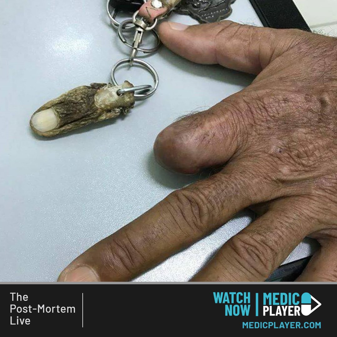 Erm..... At least its making use out of your dead finger we suppose 😮😅

LOVE all things macabre and human body related? Watch the Post-Mortem live on Medic Player for in-depth dissections, discussions, clinical pathology, and much more! 🧠

WATCH NOW ▶️ thepostmortemlive.co.uk
