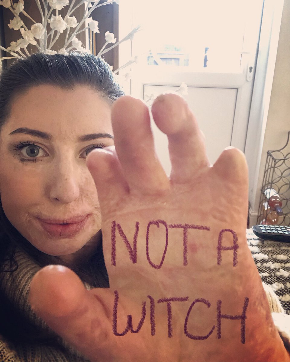CatrinPugh's tweet image. Enough children stare and are scared of me because of my scars and hand without the new #TheWitchesMovie portraying disabilities to be scary too... it’s 2020!! So much for equality 🙄 SHAME @WarnerBrosUK 
#NotAWitch #LimbDifference