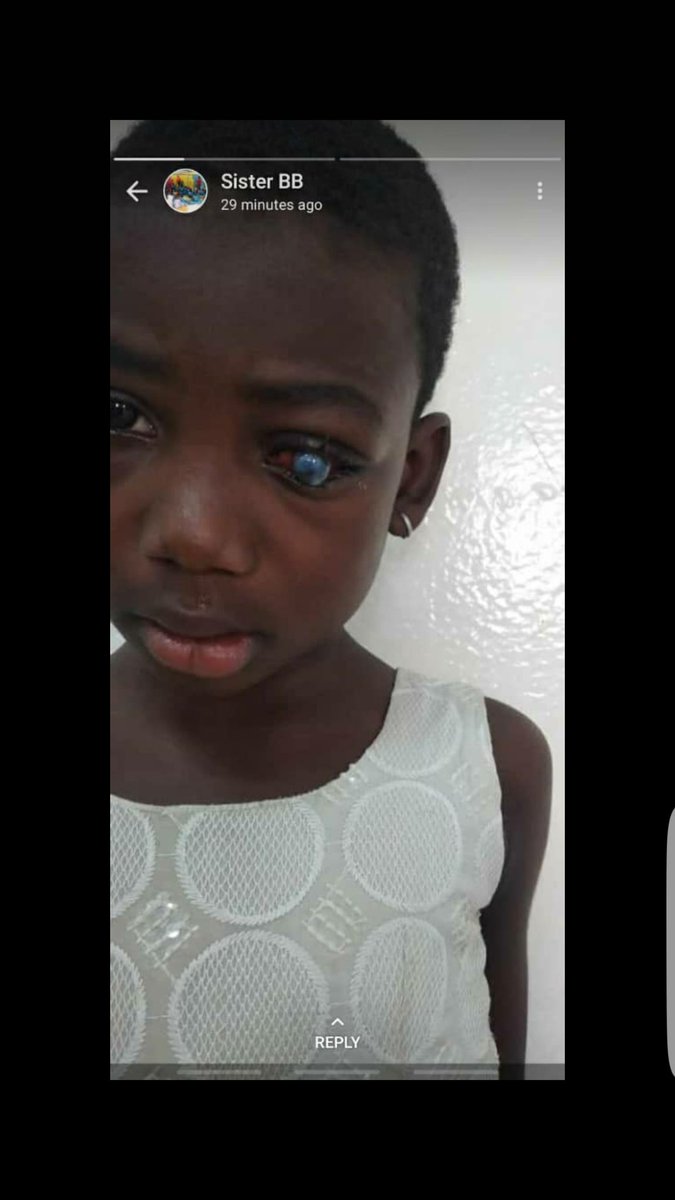 "We came across a traumatic condition and due to fear of rapture, it has been referred to Cape coast Hospital for sugery to get rid of the affected eye". This little girl was raped and while struggling to break free, the rapist pressed her eye so hard that it went in. The case wa