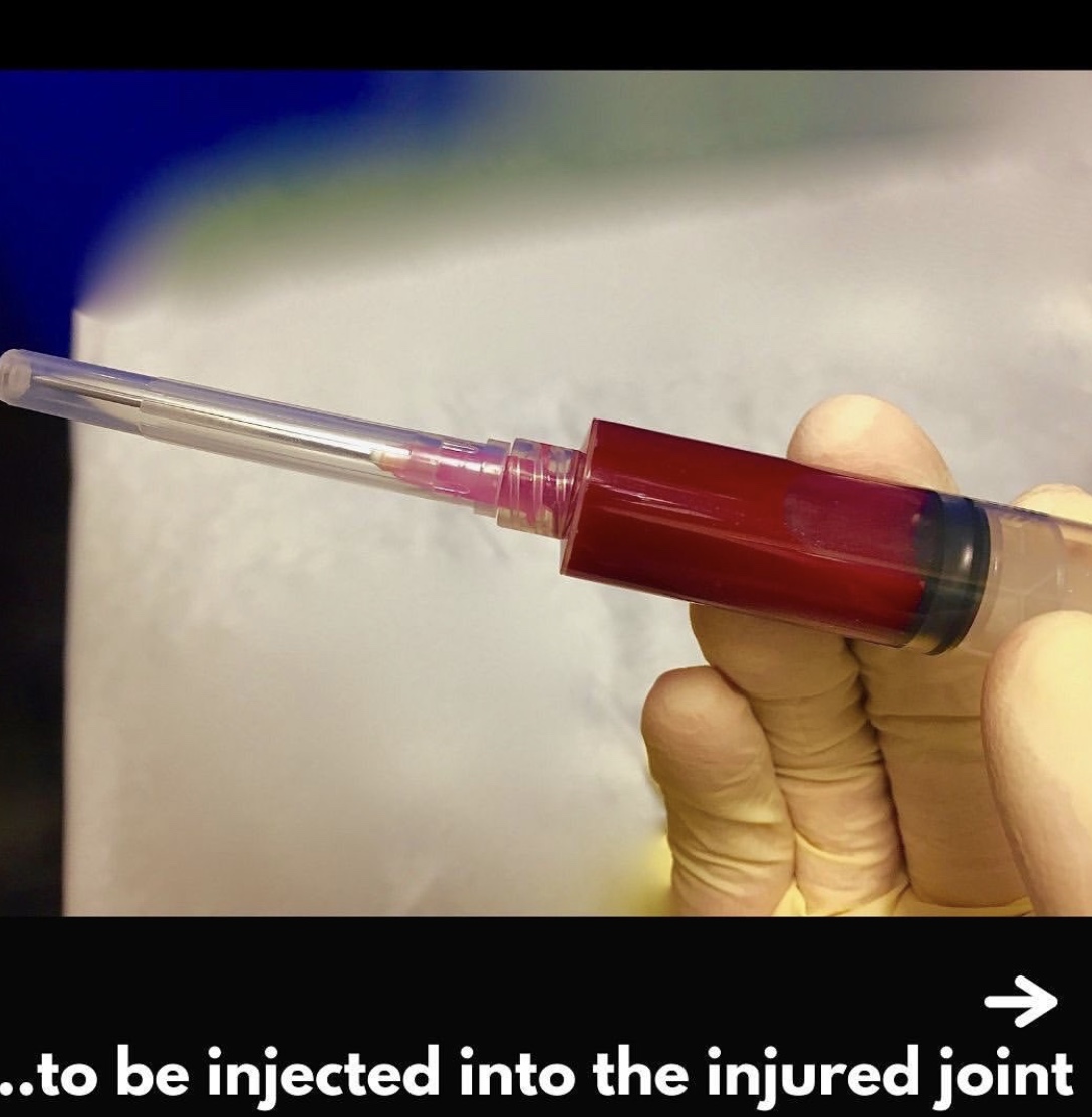 DrStevenStruhl's tweet photo. 👩🏽‍⚕️ Do you have a fracture that just won't heal? ⁣
🦴 PATIENT: 68-year-old male⁣
📋 HISTORY: Broken tibia – the rod fixation did not heal⁣
💉 THERAPY DELIVERED: Stem cell 
✅ A simple stem cell injection can lead to healing without surgery, no more pain and suffering. https://t.co/xo1fIKRASl