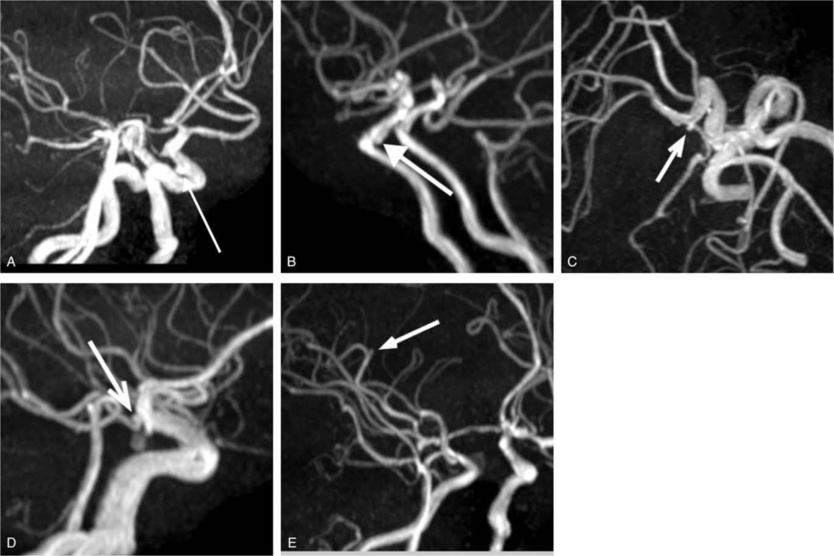 MedicineLWW's tweet photo. #Computerassisted detection (#CAD) systems based on #artificialintelligence using convolutional neural network have been successfully used for the #diagnosis of unruptured #cerebralaneurysms in experimental situations.
Read more in Medicine®: https://t.co/wKmCrt5ydc https://t.co/cRNoBtkwnq