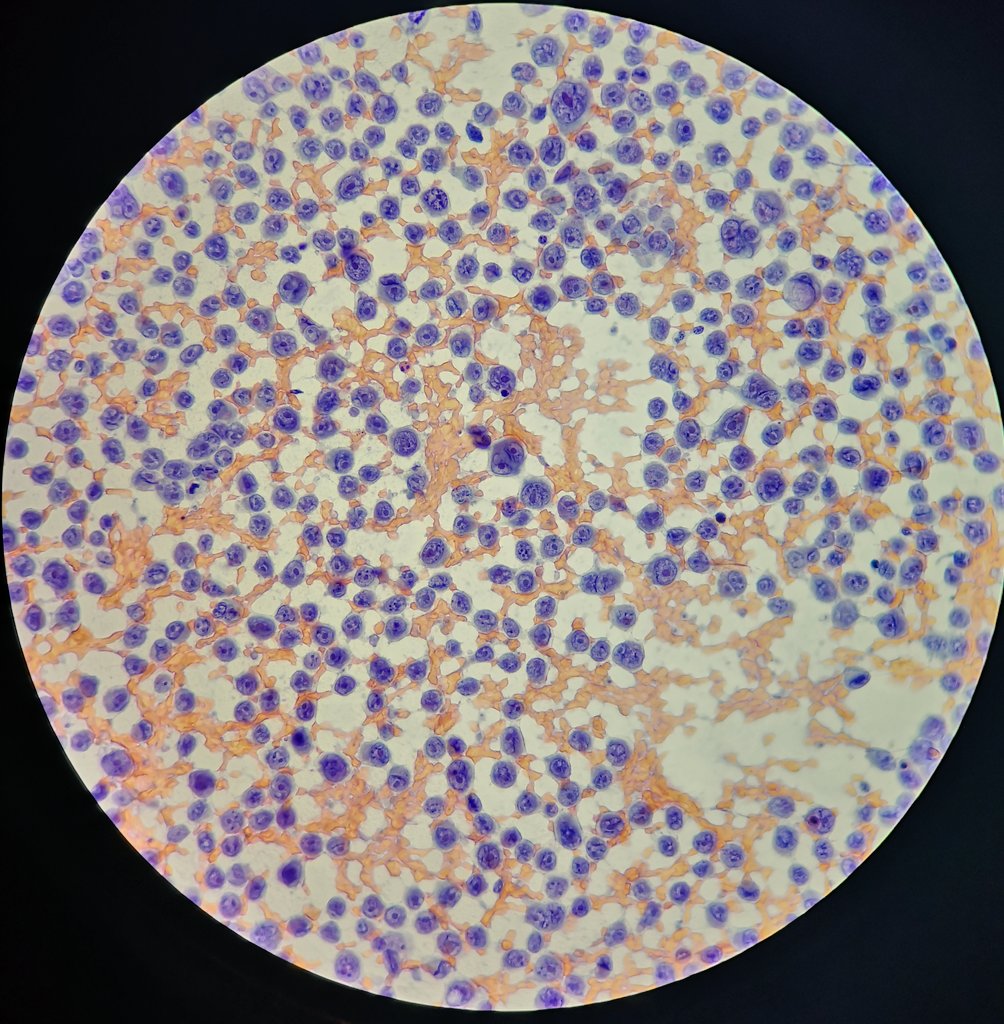 PatologiaH12O's tweet image. Nódulo en clítoris en una mujer con antecedente de melanoma vulvar.

▶️ Binucleaciones --&amp;gt;&amp;gt; 👽👽👽👽
▶️ SOX10, Melan A y S100 +.

Recidiva de melanoma.

#FNApath #cytopathology