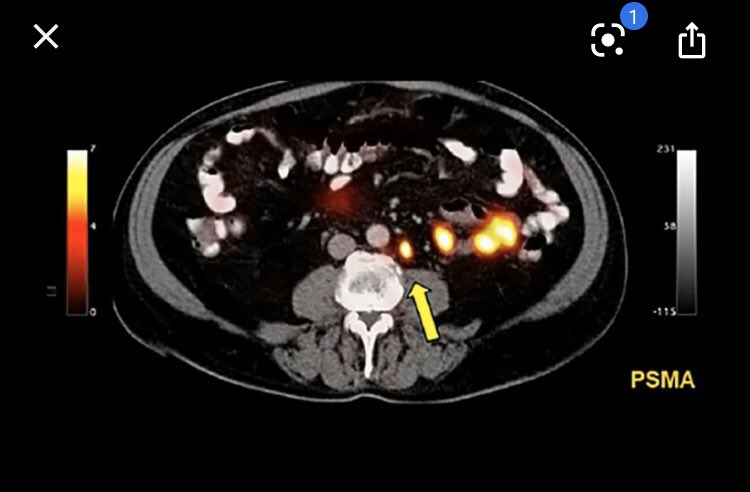 bjmiles@houstonmethodist.org (@brianmilesmdcap) on Twitter photo Happy to announce we <a href="/HMethodistUro/">Houston Methodist Urology and Residency Program</a> have a new PSMA PET and are actively recruiting for 2 studies: prostate cancer high-risk recently diagnosed and biochemical recurrence. Proud to be one of under 20 such machines in the US <a href="/DrRajSat/">Raj Satkunasivam</a> <a href="/jdhdavis/">John W. Davis, MD</a> <a href="/gpalapa2/">Ganesh Palapattu</a> <a href="/jimhumd/">Jim Hu</a> <a href="/RRGonzalezMD/">Ricardo R Gonzalez MD</a> Happy to announce we <a href="/HMethodistUro/">Houston Methodist Urology and Residency Program</a> have a new PSMA PET and are actively recruiting for 2 studies: prostate cancer high-risk recently diagnosed and biochemical recurrence. Proud to be one of under 20 such machines in the US <a href="/DrRajSat/">Raj Satkunasivam</a> <a href="/jdhdavis/">John W. Davis, MD</a> <a href="/gpalapa2/">Ganesh Palapattu</a> <a href="/jimhumd/">Jim Hu</a> <a href="/RRGonzalezMD/">Ricardo R Gonzalez MD</a>