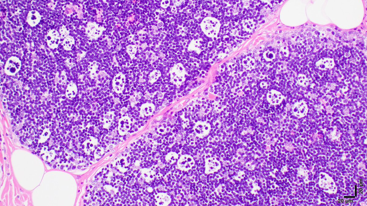 Starry sky #Pathology #PediPath #PathResidents #HemePath