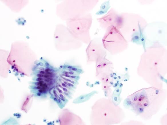 ZMaleki_cyto's tweet photo. Endocervical cells, #GYN, #SurePath #Cytopathology #83 #CytoPro @PVielh @PathPro @barkanga @PathPro @NayarRitu #pathology @britishcytology @IACytology https://t.co/nXFrbwC7Fy