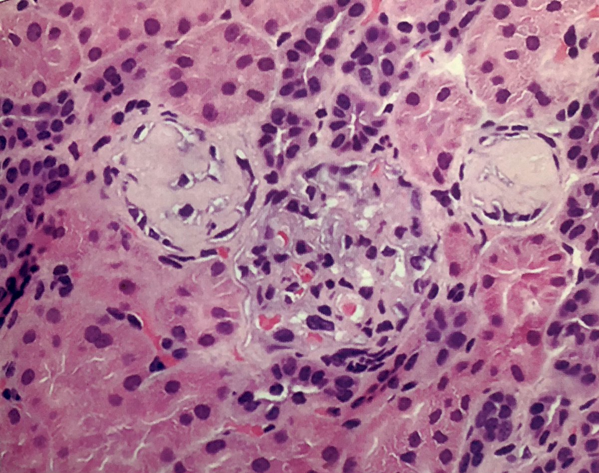 Alipathy's tweet photo. Focal Global Glomerulosclerosis may be present in a renal bx suggestive of Minimal Change Disease, especially if not associated with fibrosis and tubular atrophy. Image & Ref:Heptinstall’s Pathology of the Kidney #fact #renalfact #askrenal #kidneypathology #pathology #nephrology https://t.co/qQ2jkMqbUY