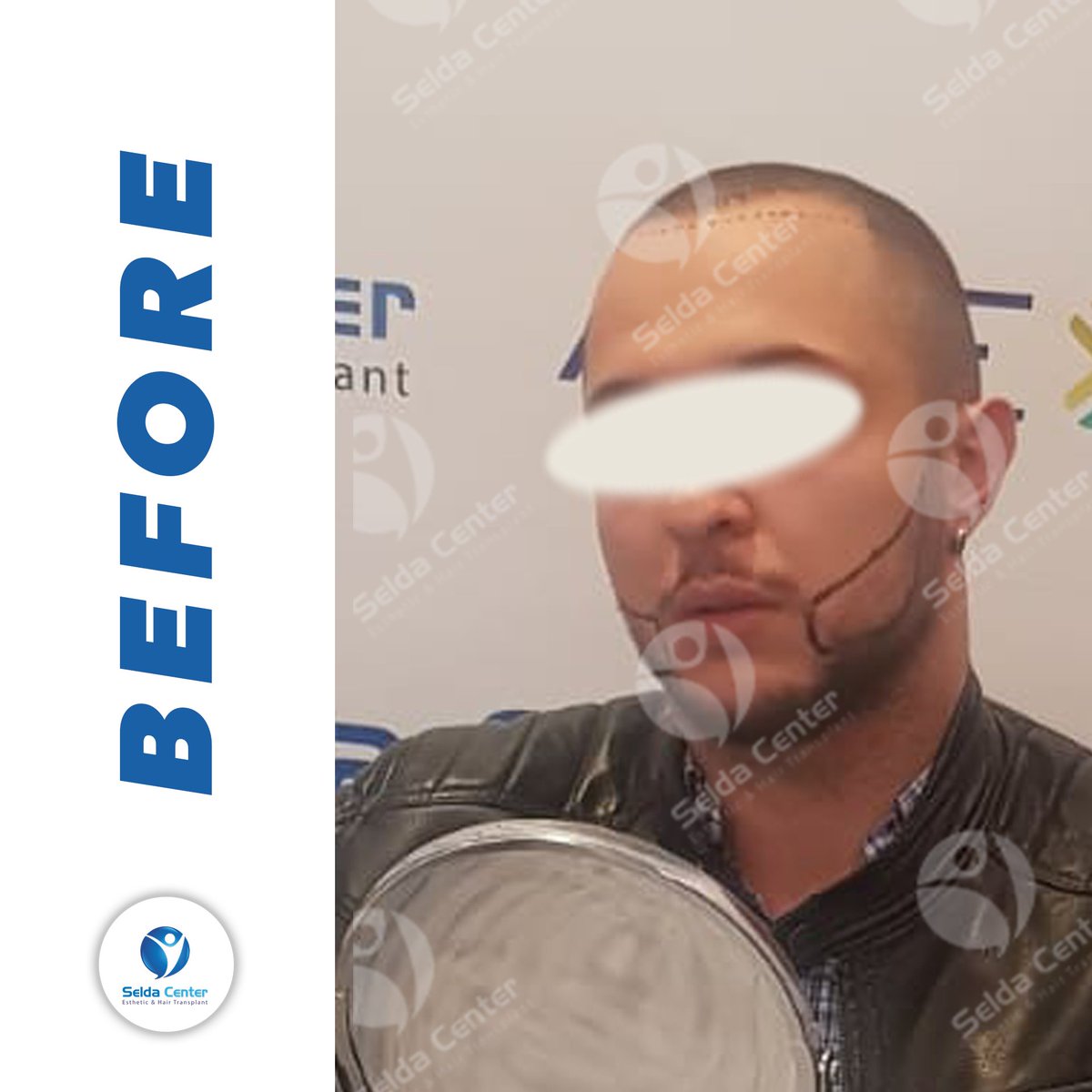 CenterSelda's tweet photo. The change of our patient, who had beard transplantation with micro FUE technique, after 8-month .
#seldacenter #sakalekimi #hairtransplant #doğalsaçlar #naturalhair #haartransplantation #transplantecapilar #trasplantecapilar #beard #beardtransplant #beforeafter #beforeandafter https://t.co/iEZeSNfS0D