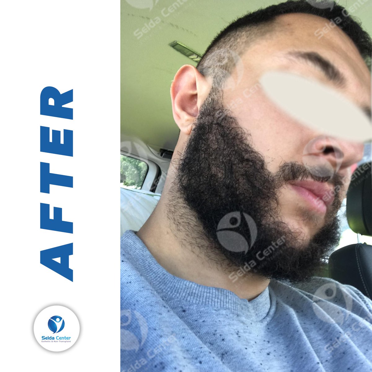 CenterSelda's tweet photo. The change of our patient, who had beard transplantation with micro FUE technique, after 8-month .
#seldacenter #sakalekimi #hairtransplant #doğalsaçlar #naturalhair #haartransplantation #transplantecapilar #trasplantecapilar #beard #beardtransplant #beforeafter #beforeandafter https://t.co/iEZeSNfS0D