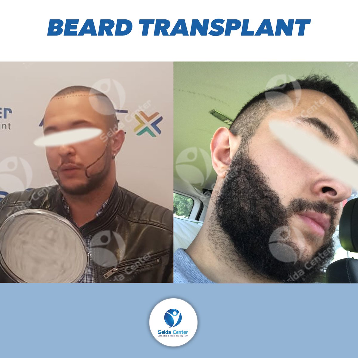 CenterSelda's tweet photo. The change of our patient, who had beard transplantation with micro FUE technique, after 8-month .
#seldacenter #sakalekimi #hairtransplant #doğalsaçlar #naturalhair #haartransplantation #transplantecapilar #trasplantecapilar #beard #beardtransplant #beforeafter #beforeandafter https://t.co/iEZeSNfS0D