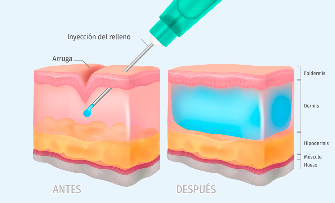 SEMEstetica's tweet photo. ¿Por qué los rellenos dérmicos debe inyectarlos un médico? Porque son productos sanitarios (Reglamento UE 2017/745) que, pese a ser introducidos mediante agujas en el interior del cuerpo humano, no actúan directamente sobre él por mecanismos... https://t.co/O20W54oNvY https://t.co/A9oxCdlb9I