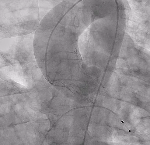 vicentejmzmd's tweet photo. 1st #PORTICO implant @ University Hospital Ramon y Cajal with novel #FlexNav delivery system... #TAVI @ASanchezRecalde @luisa_car  @AbbottCardio @crfshj @PCRonline @shci_sec @secardiologia @TCTMD https://t.co/20xIySEzar