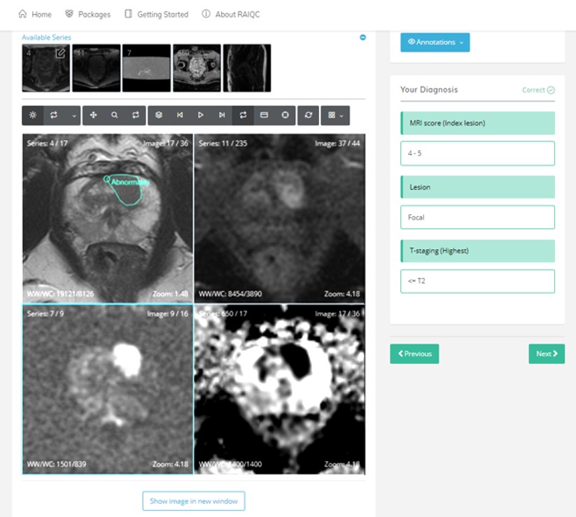 Tristan_Radiol's tweet photo. Delighted to lead the launch of the @RAIQC_tweets free on-line Prostate mpMRI education tool supported by @ProstateUK. Register https://t.co/7t9u59Oobt to view the 1st module of 25 cases! @ProfPadhani @JelleBarentsz @radiolobt @giga_fra @NickSchiedaMD @CornudF @lkayat @BonekampMd https://t.co/77r1GzteqI