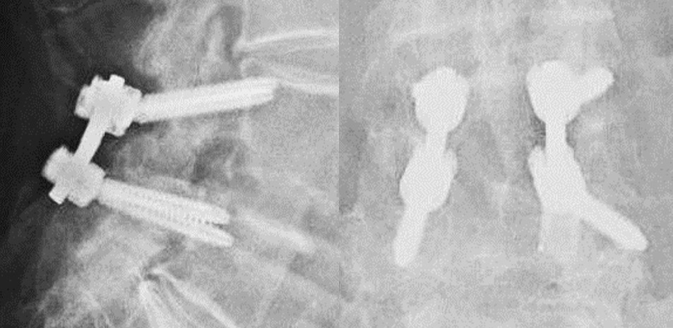 SpineWaveInc's tweet photo. Salvo® 4.75 Spine System: This is only the beginning… #NextGen #Modular #Fixation #Salvo #SpineWave https://t.co/r9w6e8VYYe