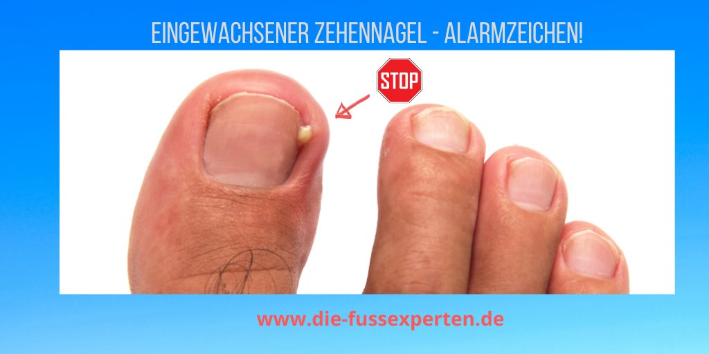 Ein eingewachsener #Zehennagel mit akuter Entzündung ist ein medizinischer Notfall!
die-fussexperten.de/eingewachsener… #fusspflege