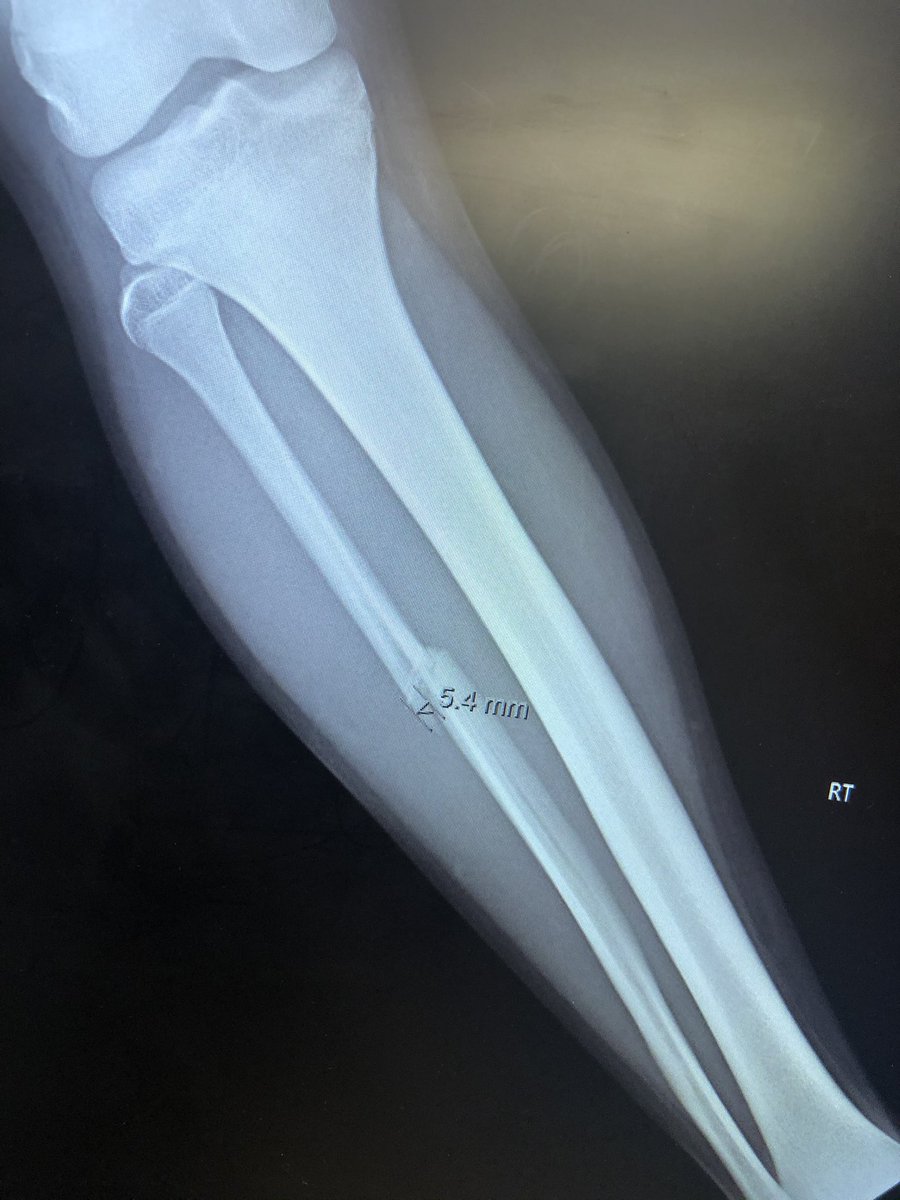 patunia22's tweet photo. Had a great season this year!  Was excited to watch him shine during playoff weeks but it ended sooner then we expected with a broken right fibula.  #smcc #2022 https://t.co/kwAGyEklW2