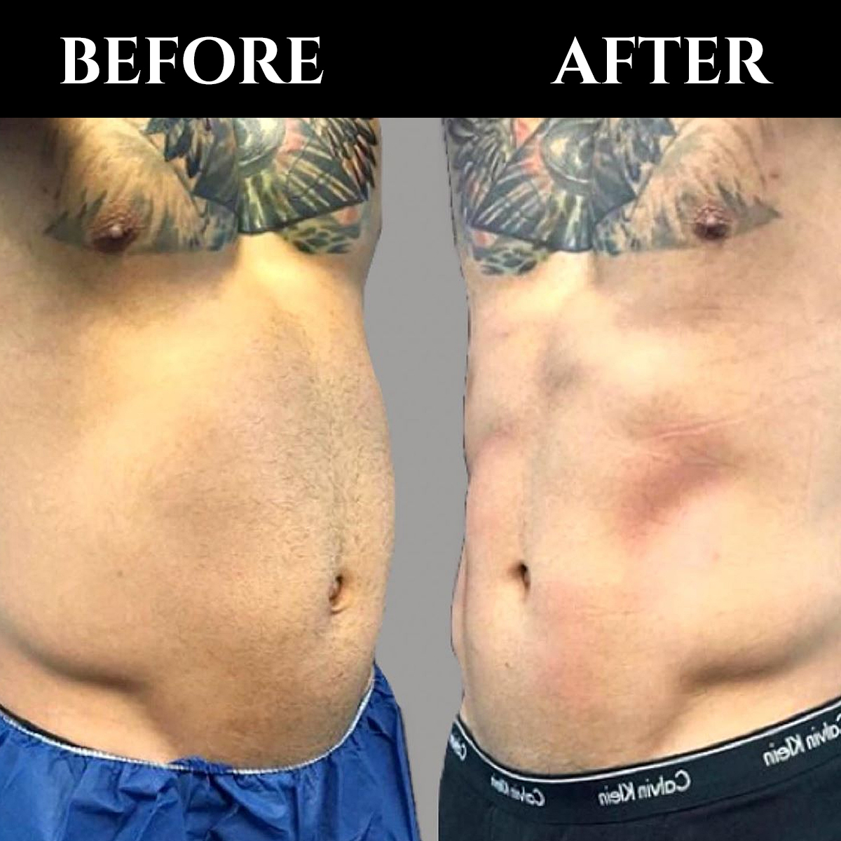 Can you see the differences?✨ truSculpt flex is a muscle sculpting device that offers personalized treatments based on patient fitness level, shape, and goals. Credits: cutera.anz #fitnessmotivation #nutrition