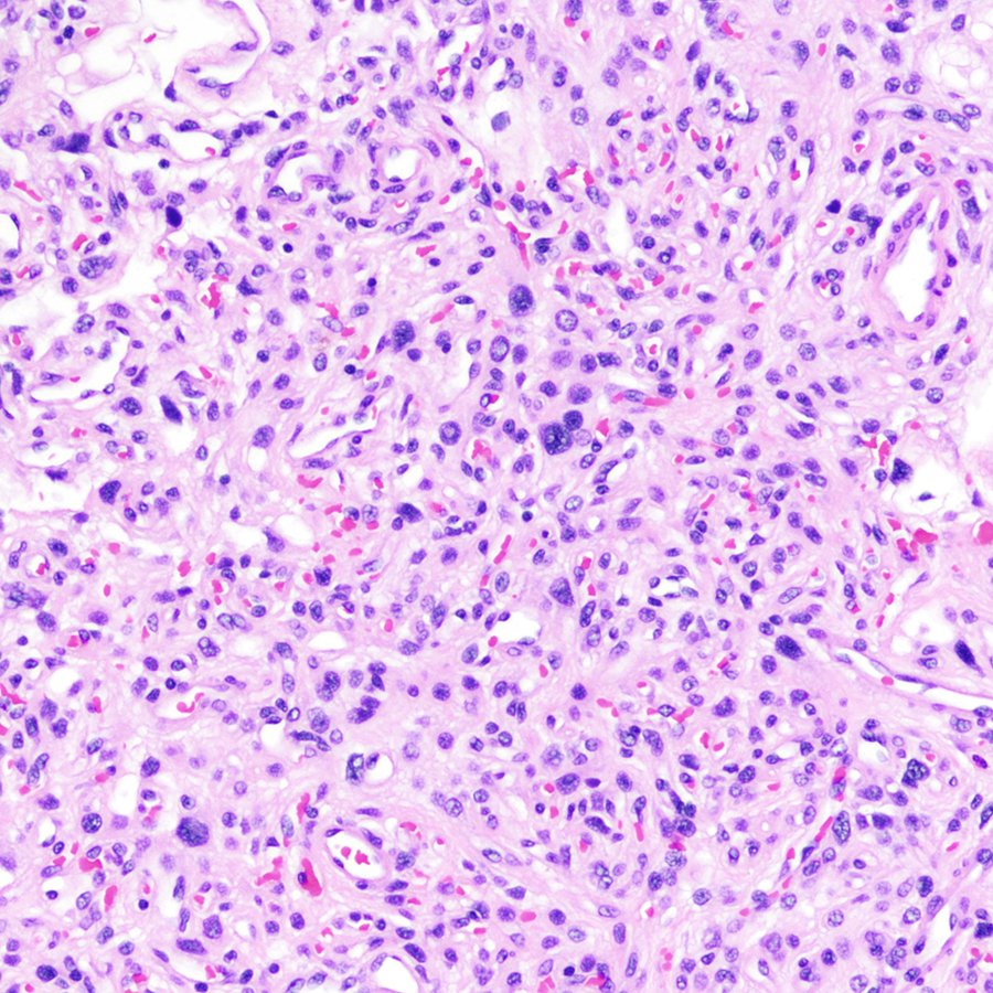 CraigHorbinski's tweet photo. #Brain tumor in a middle-aged man. IHC is on the paired tweet. Diagnosis? #pathology #neuropath #PathTwitter https://t.co/F8hIILXcoz