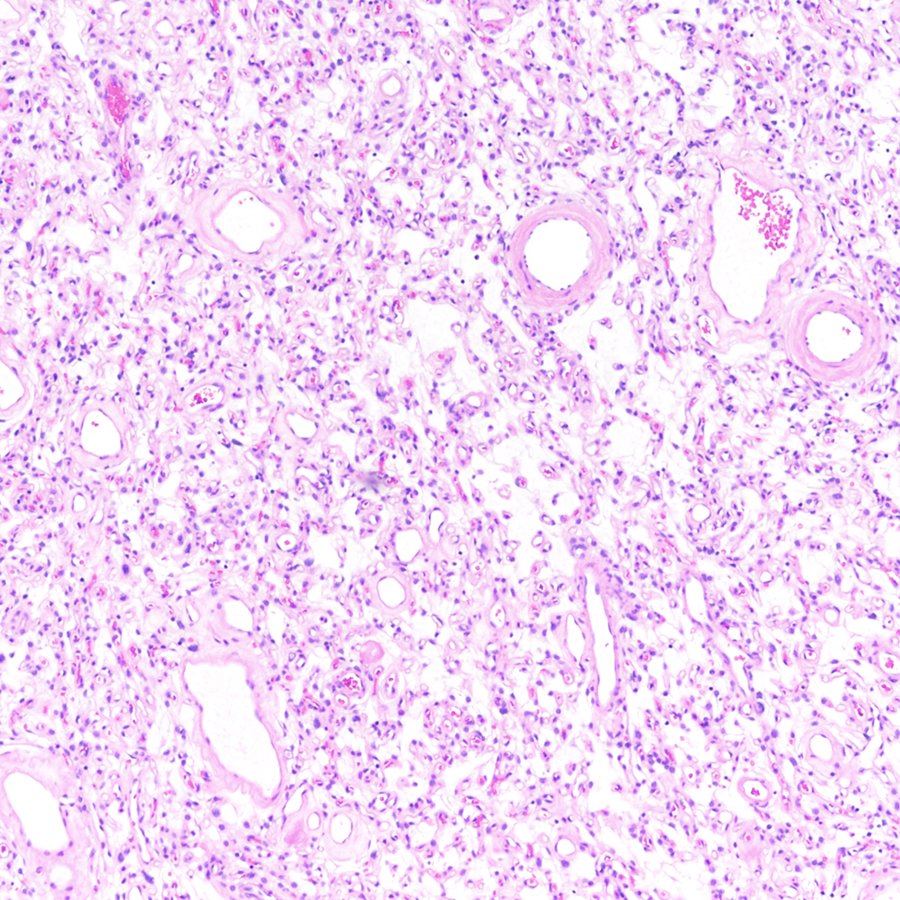 CraigHorbinski's tweet photo. #Brain tumor in a middle-aged man. IHC is on the paired tweet. Diagnosis? #pathology #neuropath #PathTwitter https://t.co/F8hIILXcoz