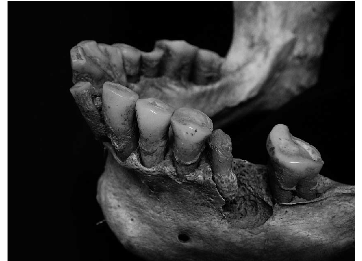 Amanda investigated several different types of pathological legions throughout the collection in order to determine frailty. These indicators included linear enamel hypoplasia, femoral length, periodontal (gum) disease, periostosis, & the diameter of the vertebral-neural canal.