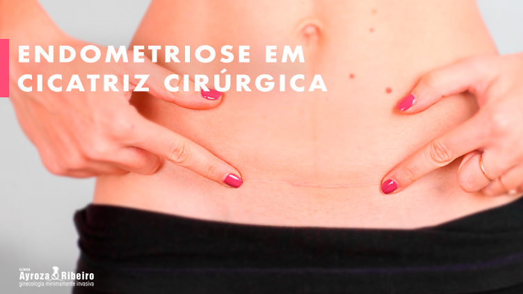 O que é Hematometria? – Clínica Ayroza Ribeiro