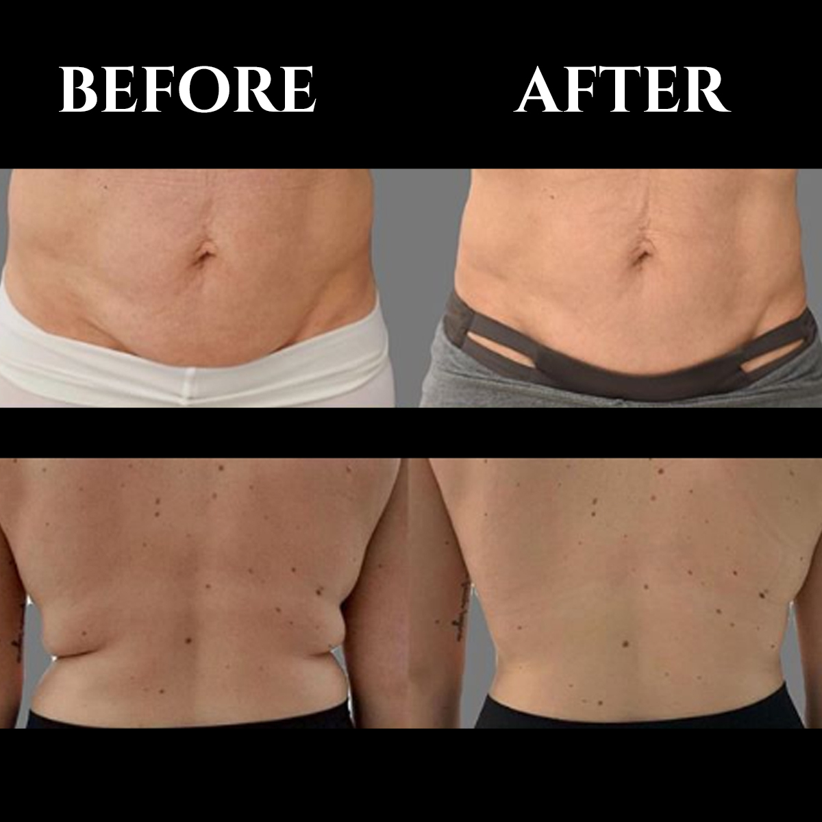 👉Can you see the differences? Either you want to get rid of your love handles or firm your abs, truSculpt iD can make your journey a good experience to say bye to your quarantine 15. Credits: cutera.anz #ProvidenceRI #AntiAging