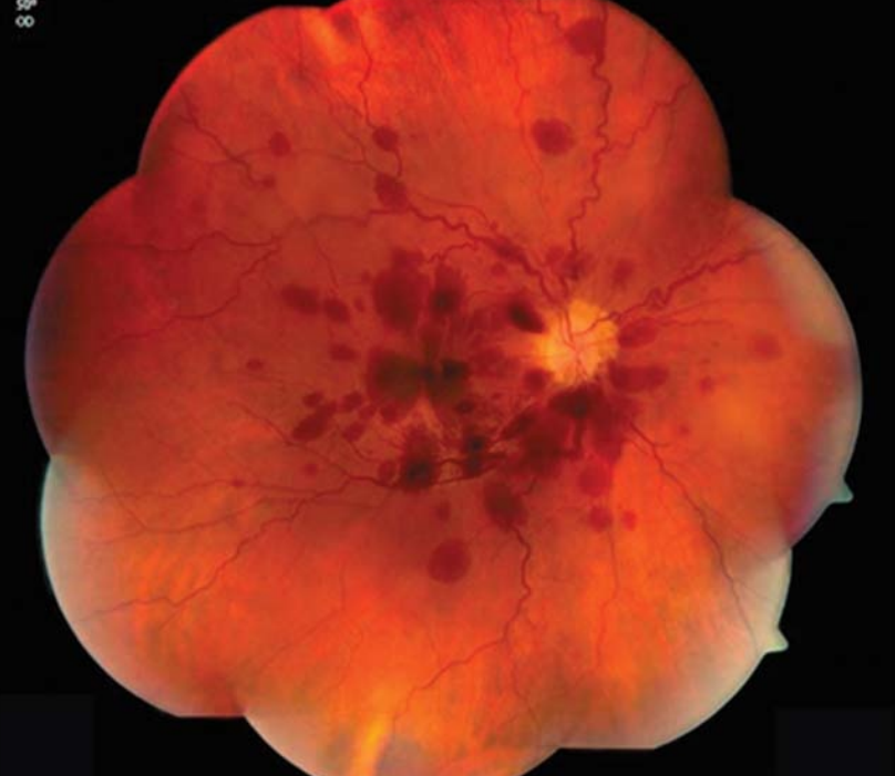 fgiloarrojo's tweet photo. Acute vision loss secondary to #epiduralbloodpatch
#Tersonsyndrome (Gabriel L. Pagani-Estévez et al)
https://t.co/REtnZILI5e https://t.co/qHFpiyzzXD