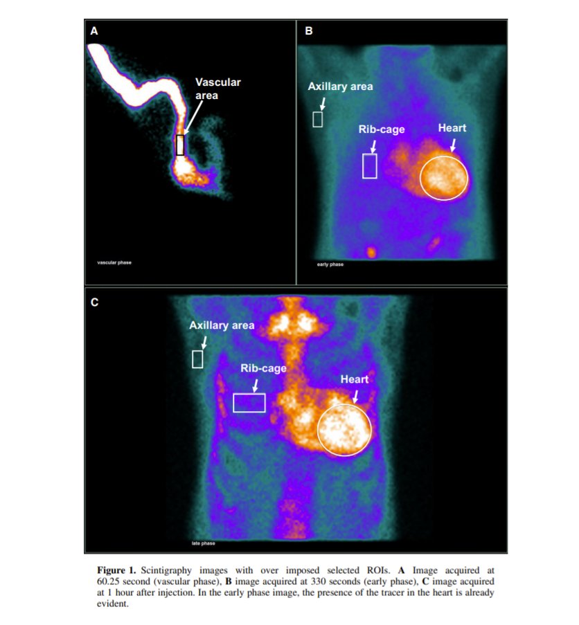 #JournalNC: Use of early (10 min) image acquisition on planar 99mTc-HMPD promising in #ATTR #amyloid diagnosis. 

#CVNuc @myasnc <a href="/DorbalaSharmila/">Sharmila Dorbala</a> <a href="/BrettSperryMD/">Brett Sperry, MD</a> <a href="/MasriAhmadMD/">Ahmad Masri</a> @myASNC 

👉Learn more: bit.ly/3jq255d