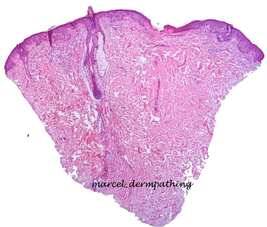 arakakiasato's tweet photo. Keratosis pilaris: disorder of keratinization involving the infundibullum of the follicle. We can see a follicular plug filling the infundibulum and protruding above the surface.(Weedon’s Skin Pathogy) #dermatopathology #pathology #dermatology #keratosispilaris https://t.co/KgMBhCVheB