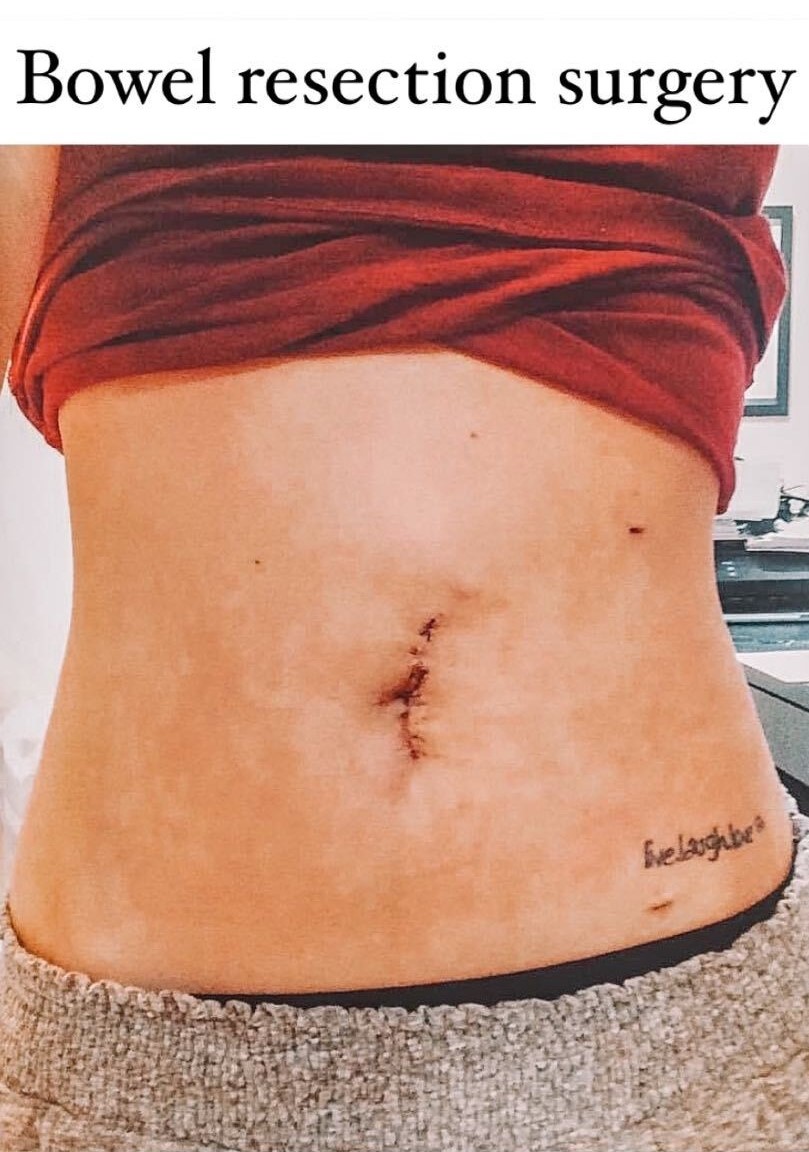 GaliHealth's tweet photo. As we continue sharing the community’s surgery stories this month, Krista shares her experience with two resections and loving her scars.
Read the full story here: https://t.co/azJl4erene
#crohnsandcolitis #resectionsurgery #ostomy https://t.co/8KLHBywl7h