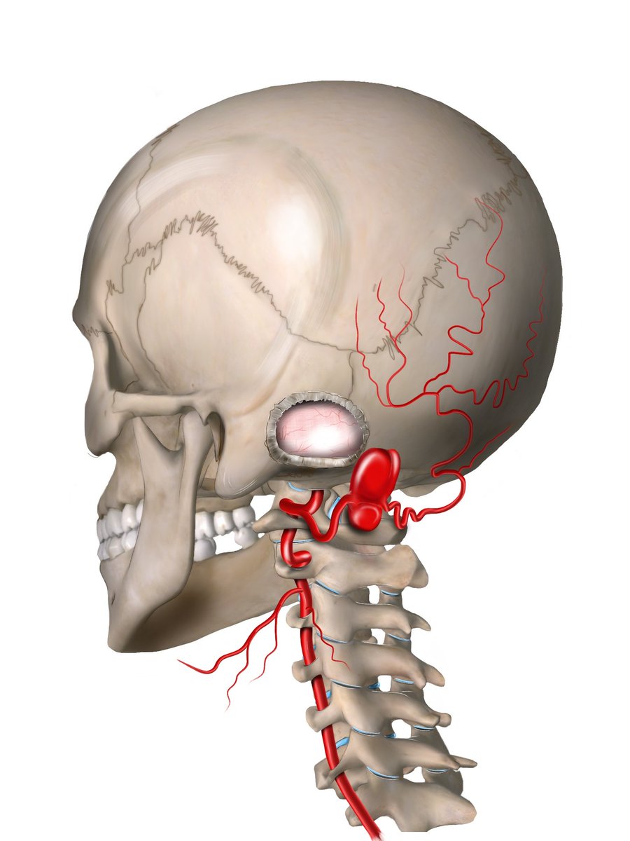 Visish M. Srinivasan, MD (@visishs) on Twitter photo Surprised to come across this illustration used for a talk for VA-PICA #aneurysms! Our case was actually an OA pseudoaneurysm after retrosigmoid craniotomy. Illustration by Dr. Jovany Cruz <a href="/BCMNeurosurgery/">BCM Neurosurgery</a>.
pubmed.ncbi.nlm.nih.gov/28017755/ Surprised to come across this illustration used for a talk for VA-PICA #aneurysms! Our case was actually an OA pseudoaneurysm after retrosigmoid craniotomy. Illustration by Dr. Jovany Cruz <a href="/BCMNeurosurgery/">BCM Neurosurgery</a>.
pubmed.ncbi.nlm.nih.gov/28017755/