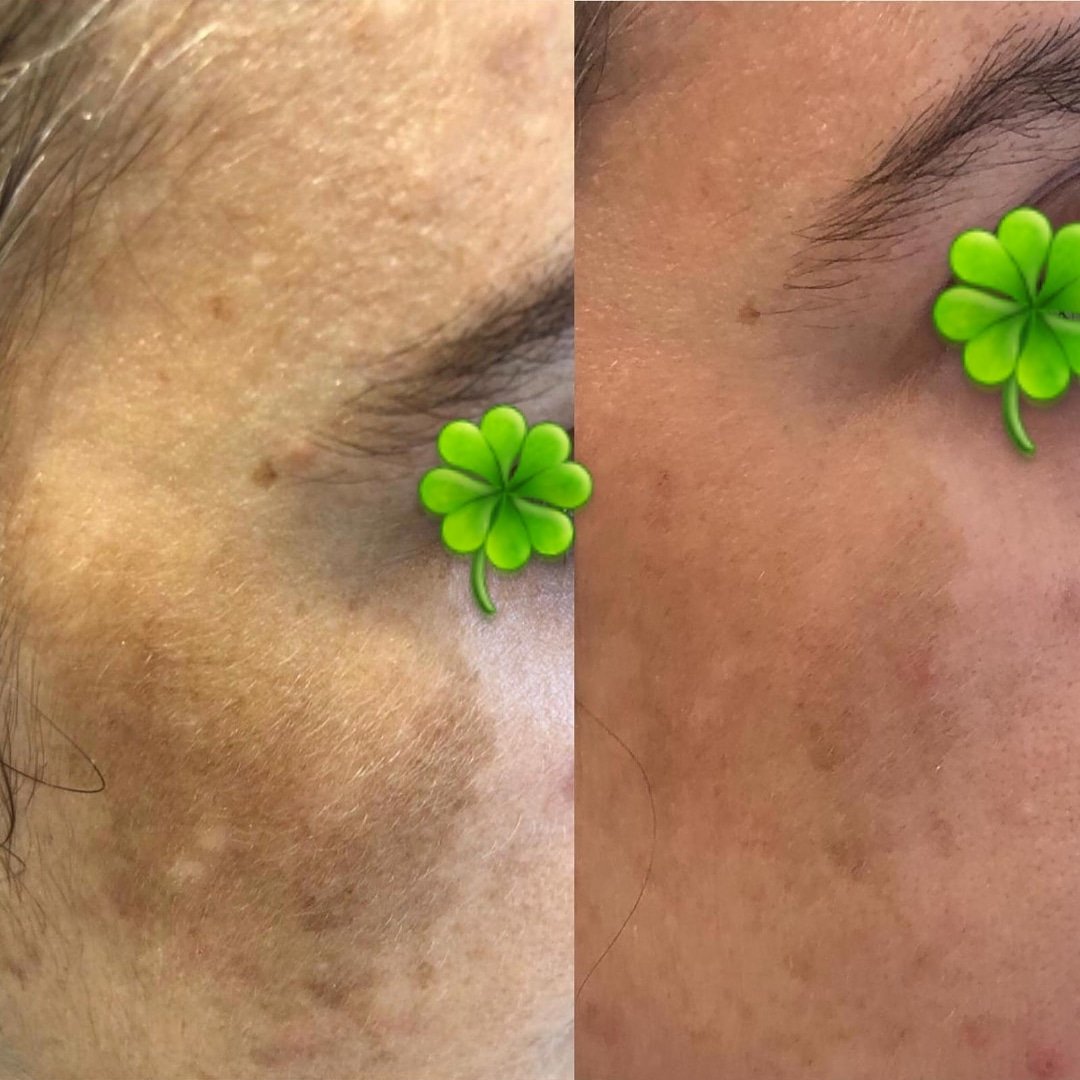 Güneş lekelerinin boyutu, derinliği ve türünün tespiti gerçek anlamda çözümün başlangıcıdır. Seda Sakacı Cosmetology 'de önce  tespit sonra da nokta atışı çözüm bulunur. 
Danışanımızın ilk seans sonrasi lekelerindeki azalma; bilimsel ve bütünsel güzelliğin kanıtıdır.