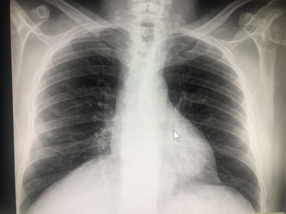 oyuguero's tweet image. Pacient de 56 anys, hipertens. Al 2n      dia de febre i tos, radiografia neta. Covid Positiu. 5 dies despres, pneumònia bilateral, i distrés respiratori. Contagi en entorn familiar. No és cap broma. #COVID19 #salut #Lleida