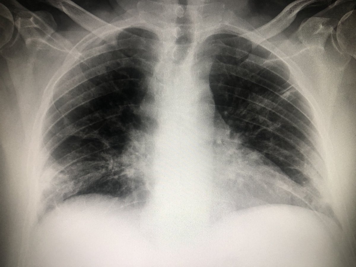 oyuguero's tweet image. Pacient de 56 anys, hipertens. Al 2n      dia de febre i tos, radiografia neta. Covid Positiu. 5 dies despres, pneumònia bilateral, i distrés respiratori. Contagi en entorn familiar. No és cap broma. #COVID19 #salut #Lleida