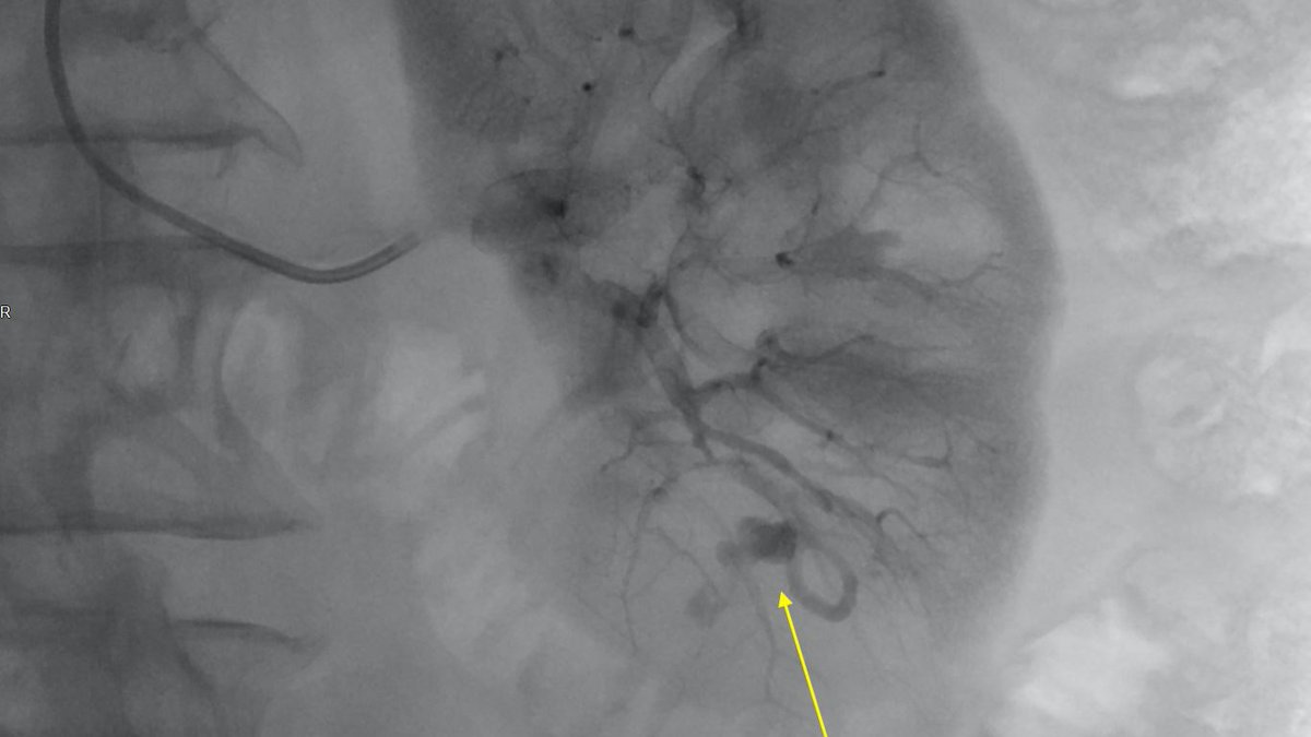 michaeldburns's tweet photo. The importance of checking with doppler US before biopsy!
2 years post partial nephrectomy for RCC. CT shows ?tumor recurrence. Sent for biopsy where pseudoaneurysm is picked up on preliminary US. Embolized via #RadialFirst 
#irad
#minimallyinvasive
@CAIRweb @SIR_ECS https://t.co/v7V24xx83I