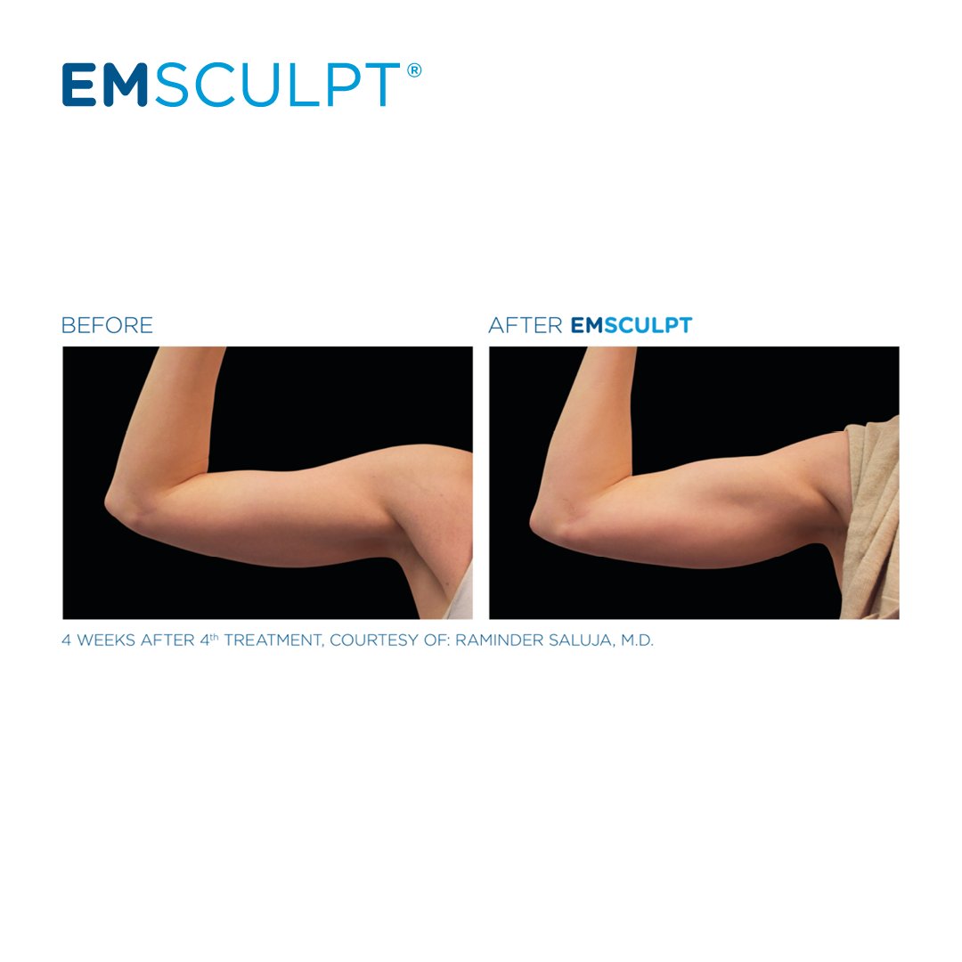 WestsideLaserCA's tweet photo. EMSCULPT®’s non-invasive muscle toning and fat reduction have been shown to be safe and effective on any body type. It offers an effective solution for men and women 💪 

Call us at 403.685.0110 to book your free consultation today to find out how EMSCULPT® can work for you! https://t.co/nEsF0bnlCX