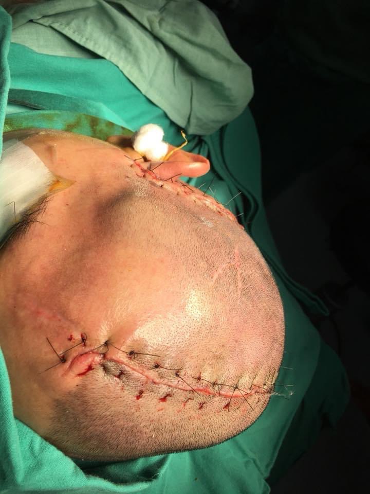 RicQC503's tweet photo. Nuestro amigo tuvo un accidente de moto, destruyó su craneo pero salvamos su vida Gracias a Dios!!! Dr y ustedes qué hacen? Remodélamos cabezas Jajajja. Malla de Titanio remodelada con reconstrucción 3D justa para cada persona. 😎🙏 nuestro oficio. https://t.co/OdRxgcyhnj