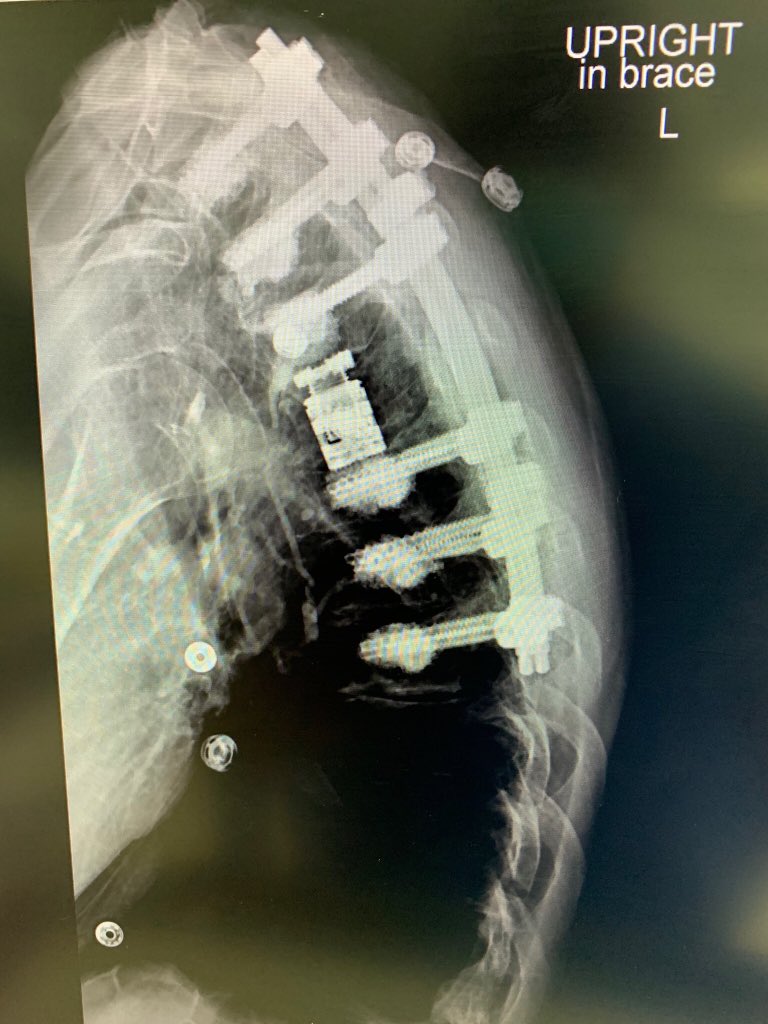 bryceolson's tweet image. And #WTfix? Here’s the fix! My new bionic back:-) We sequenced the tumor’s genomics and the results will guide a future therapy. #SequenceMe