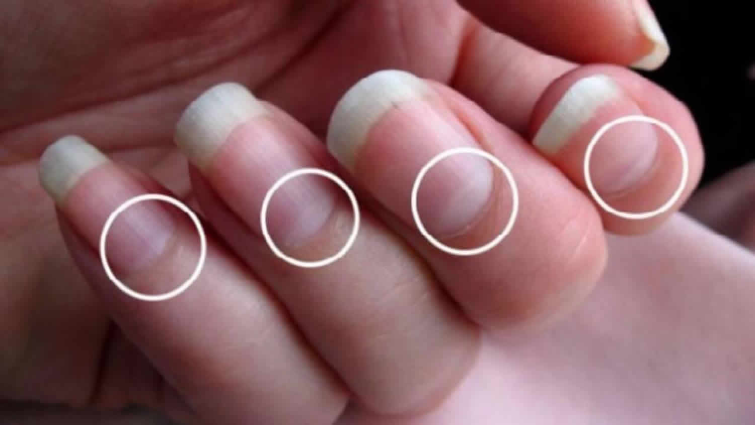I only have a lunula on my right thumb, should I be worried that I could  not find it on my other fingers? - Quora