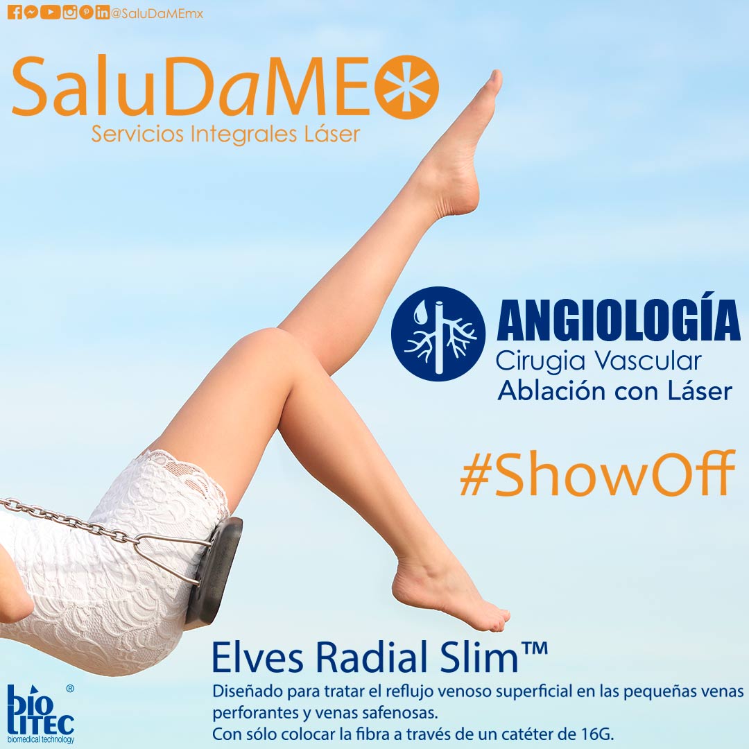 ANGIOLOGIA
Cirugia Vascular
Ablacion con Laser
Elves Radial Slim™
Diseñado para tratar el reflujo venoso superficial en las pequeñas venas
perforantes y venas safenosas.
Con sólo colocar la fibra a través de un catéter de 16G.
#ShowOff
@saludamemx | hola@saludame.mx. https://t.co/RLnRyrRFOn