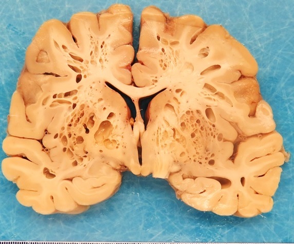 DrSwatiBhardwaj's tweet photo. I was told that this is not an uncommon finding in autopsies, but it literally made me gasp 😲. Any idea what's going on in these organs? What are these almost "swiss-cheese" holes? https://t.co/8lrMIH25Ha