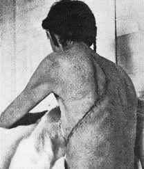 SurgeryLegends's tweet photo. German born surgeon Franz Torek (1861-1938) performed the first successful transthoracic esophagectomy for cancer on March 14, 1938, at the German (now Lenox Hill) Hospital in NYC. The patient, a 67 year old woman, survived for 12 years after the operation, dying of pneumonia. https://t.co/9LBQts5Aa2