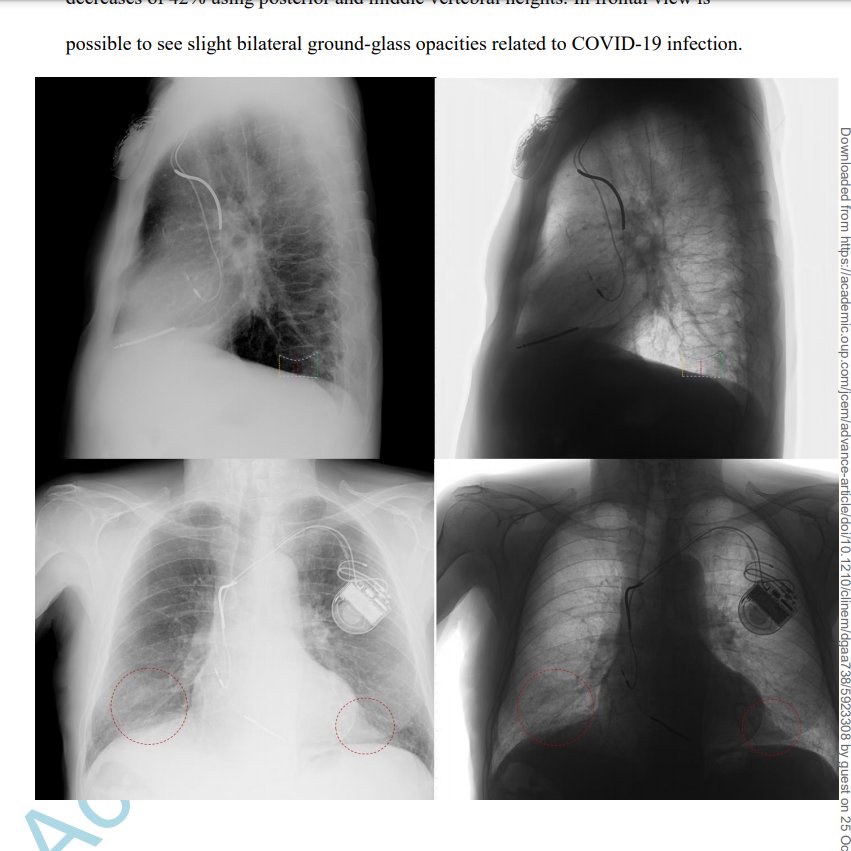 doctorneyro's tweet photo. #VFs integrates the cardrspirtry #risk of #COVID19 #patients, being a useful to measure #clinicalmarker of #fragility and poor prgnsis. 

The #morphometric thorcic #vertebral evaluation should be perfrmed in all suspcted patients undergoing a #chestXrays.

https://t.co/t7n8tpayiG https://t.co/beuADuBfc5