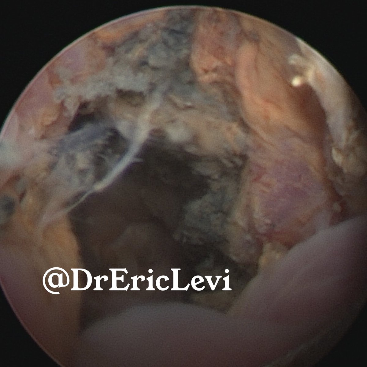 Here is what the internal lining of the oesophagus look like when a button battery has been there for a time.