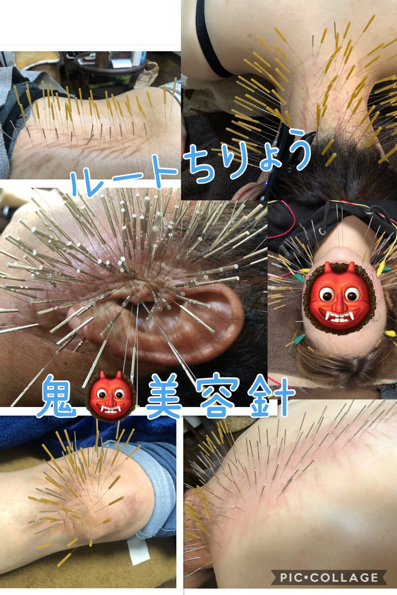 みらい鍼灸院 Miraishinkyuin Twitter みらい鍼灸院 Miraishinkyuin Twitter