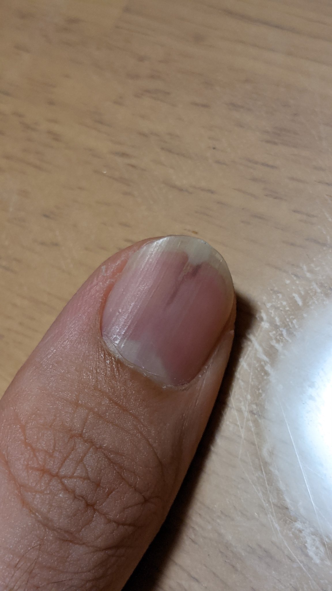 Furusin 親指の爪がこんな状態になってめちゃくちゃ痛いんだけど何これ