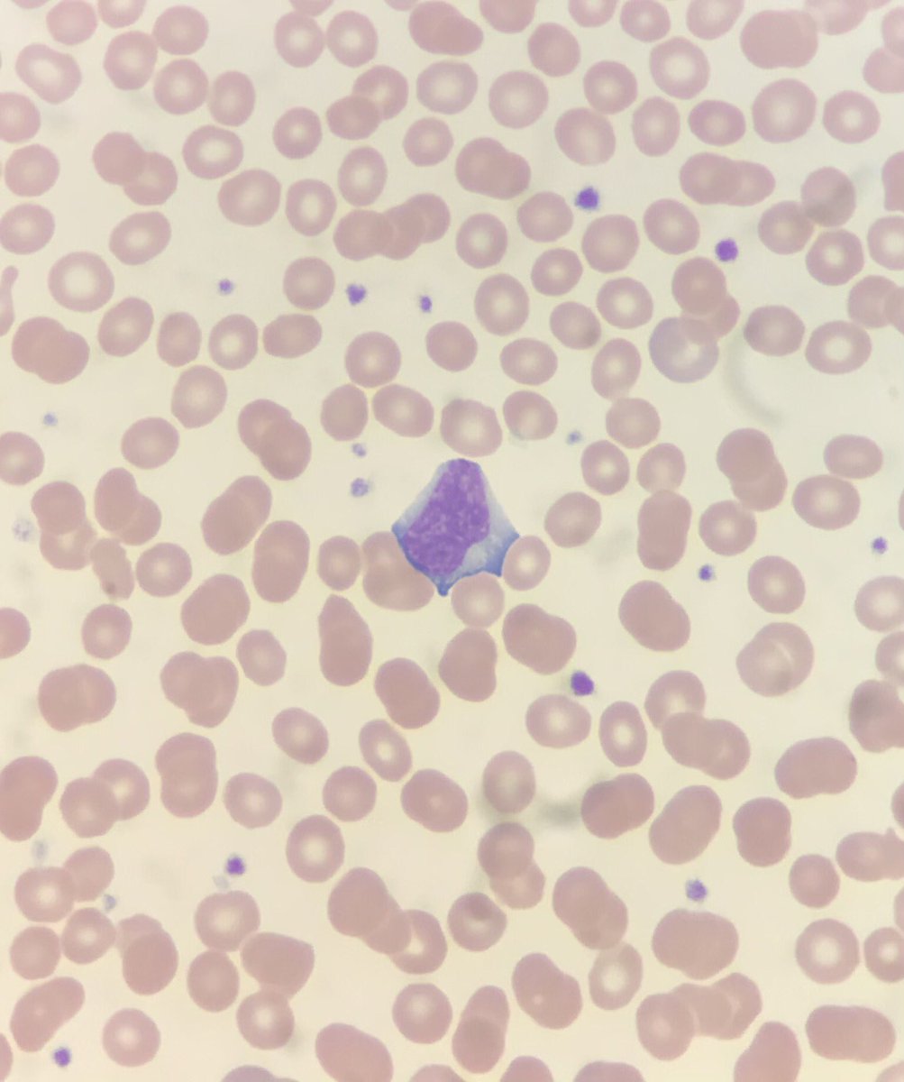 Numerous lymphocytes like this one on a smear review of a teenager presenting with pharyngitis and low grade fever. Can anyone guess results of the Monospot test? #blooducation