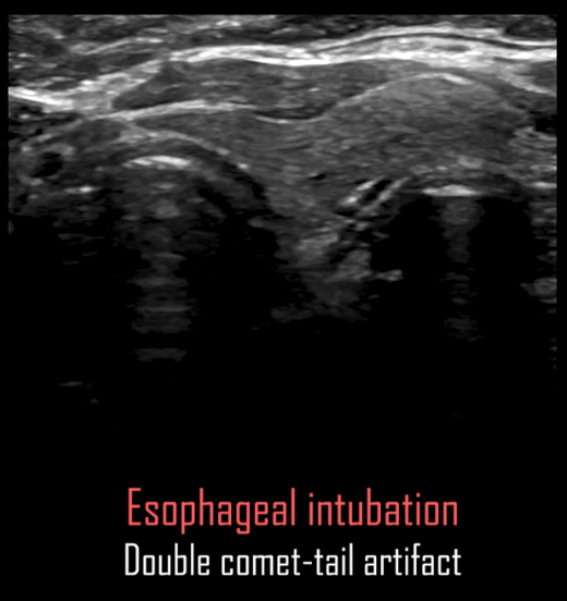 Stamatis Baronos (@theicudoc) on Twitter photo Ultrasound Assisted Intubation from <a href="/GabrielPradaMD/">Gabriel Prada MD</a> . For full lecture see link in description #FOAMed #COVID19 #ICU #criticalcare @akbarherekar Ultrasound Assisted Intubation from <a href="/GabrielPradaMD/">Gabriel Prada MD</a> . For full lecture see link in description #FOAMed #COVID19 #ICU #criticalcare @akbarherekar