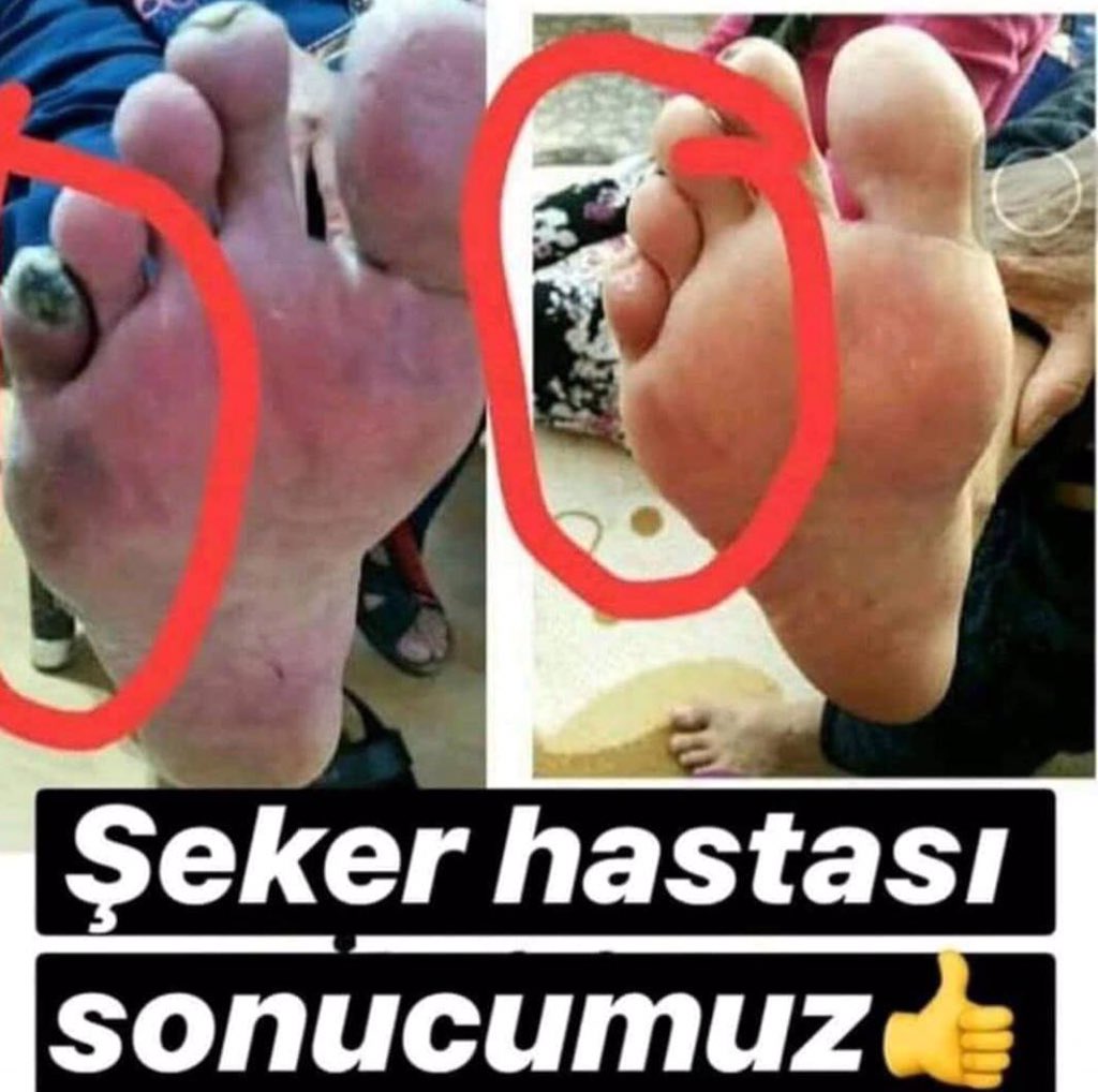 serpillyildiz's tweet photo. #şekerhastalığı #medicalband #sağlık #Health #NETWORKMARKETING 💙 https://t.co/phtn1PBkoZ